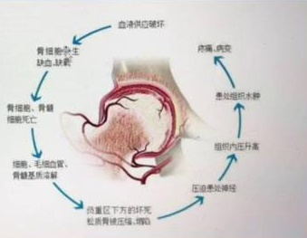 治疗股骨头坏死秘方_骨头坏死 治疗_胡骨头坏死怎么治疗