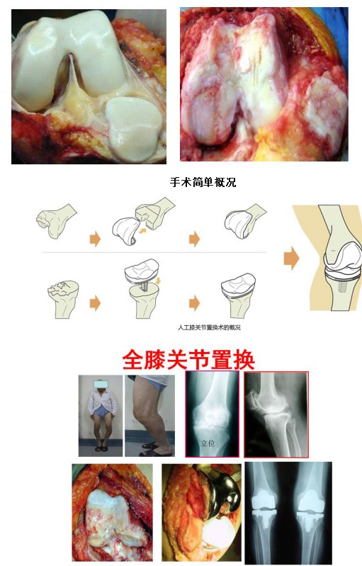 如何治疗骨骨头坏死_治疗股骨头坏死秘方_中医治疗骨骨头坏死