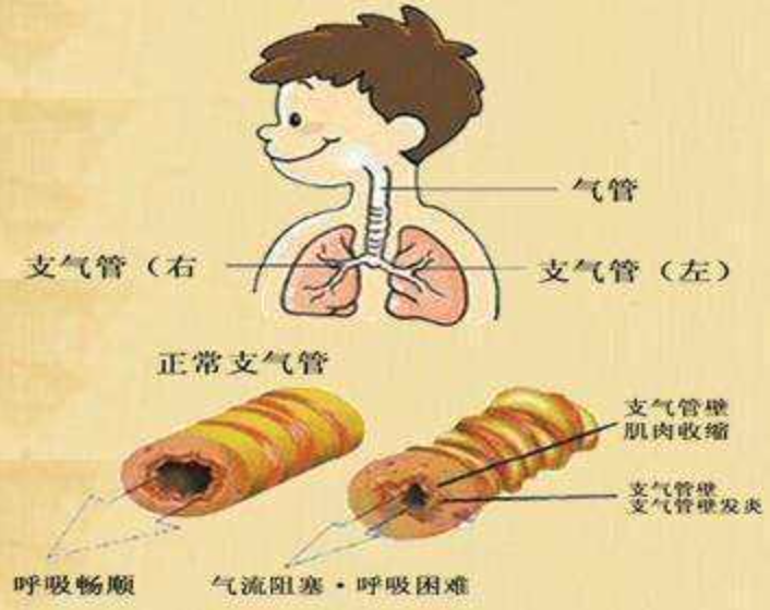 治疗气管炎的偏方_胃糜烂性十二指肠炎治疗偏方_根治气管炎的偏方