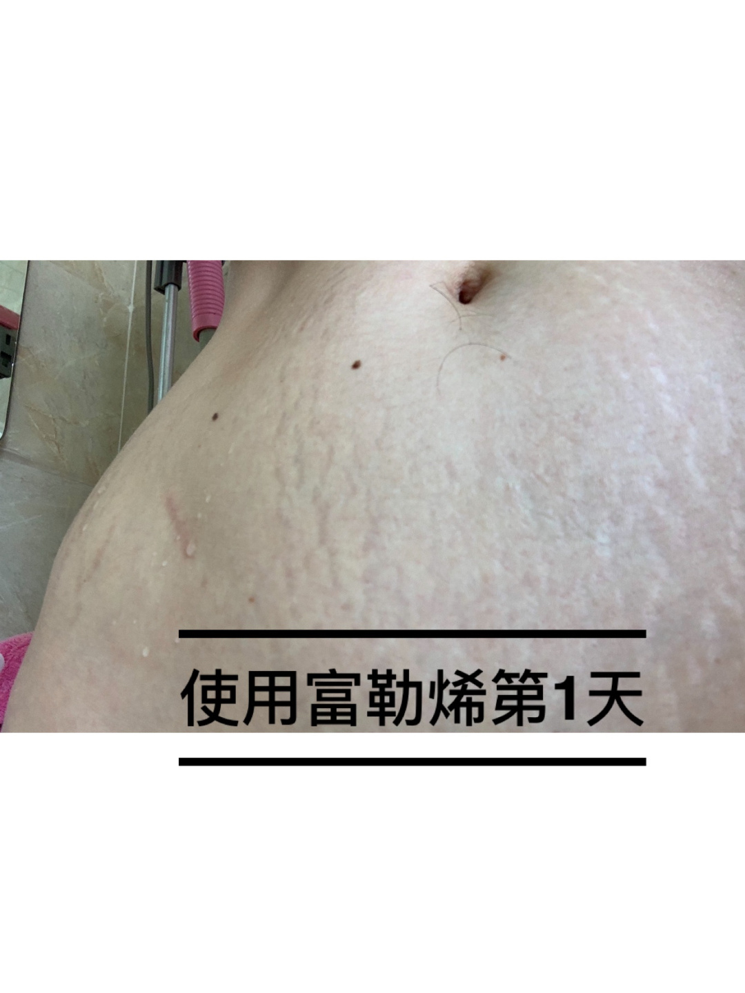 去妊娠纹偏方_月子里怎样去妊娠纹_橄榄油去妊娠纹