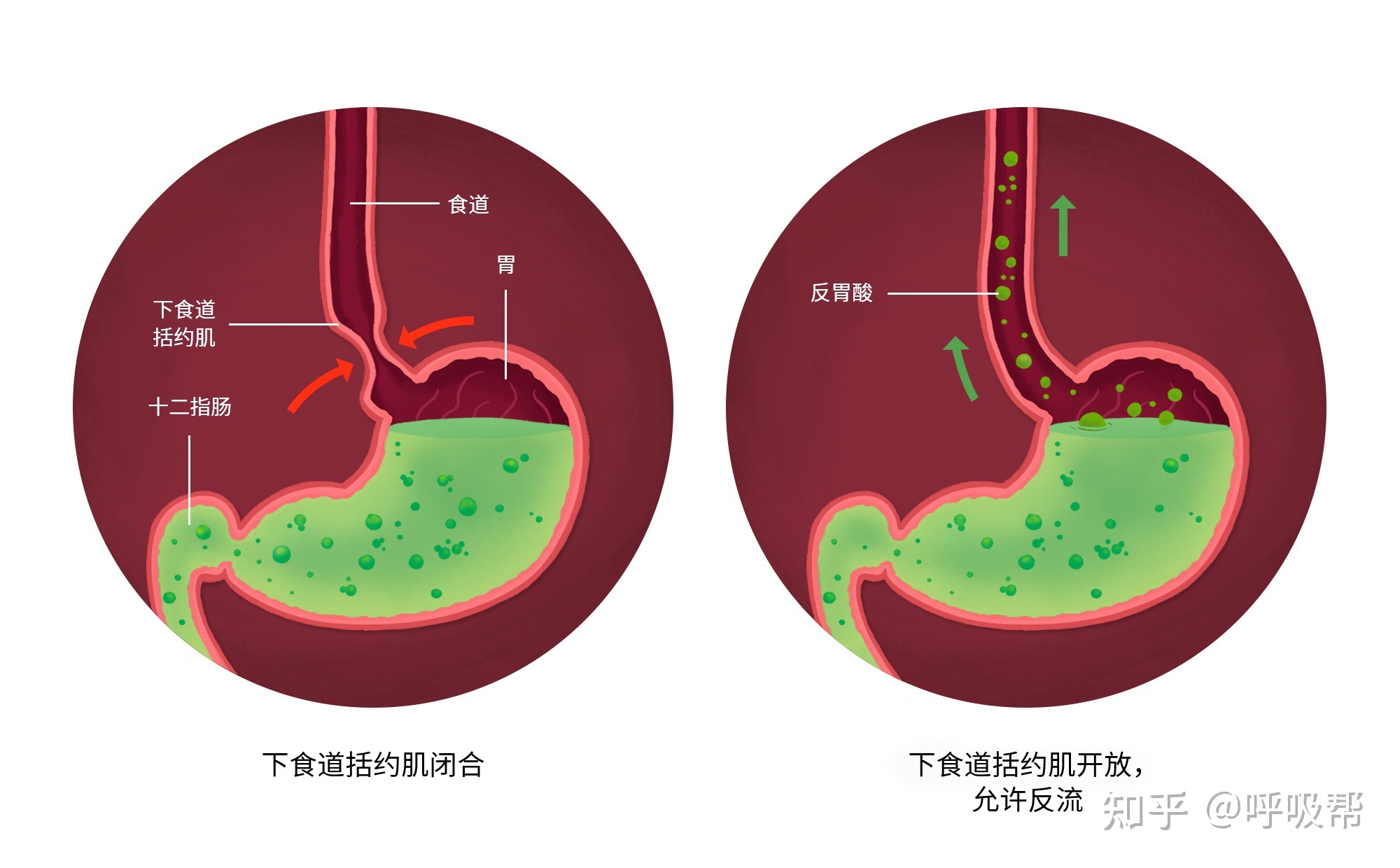 乌贼骨白芨治胃糜烂吗溃疡_祥康治胃糜烂偏方_治胃糜烂验方