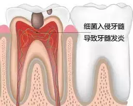 牙疼不会要命，用偏方才会