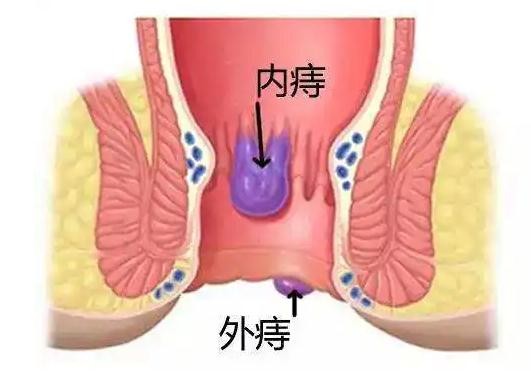 轻微外痔图片(自查痔疮症状)