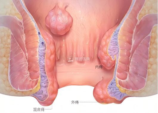 轻微外痔图片(自查痔疮症状)