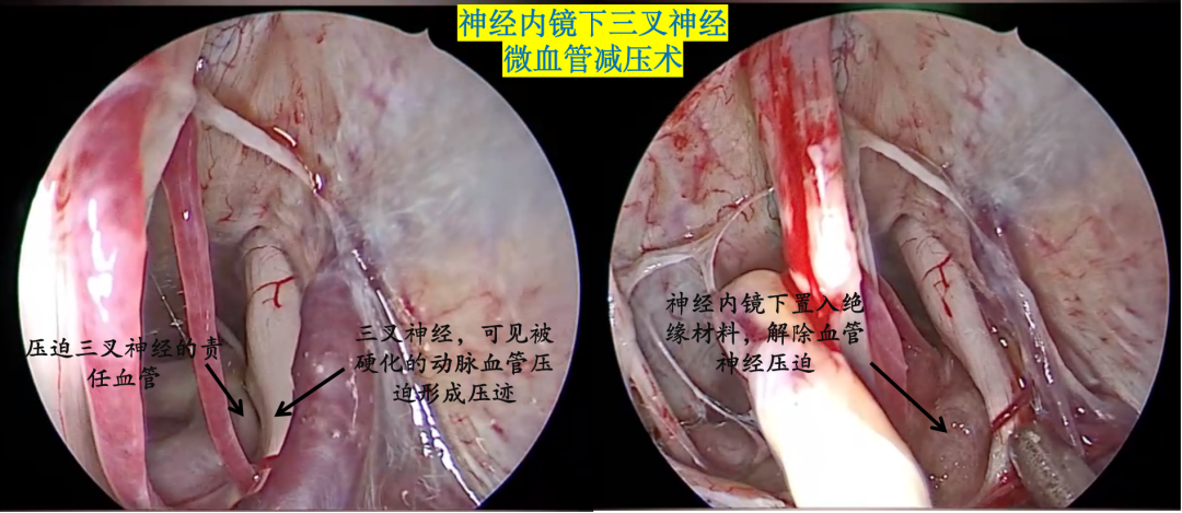 偏方治好了我的三叉神经痛_治腰间盘有没有什么好偏方_治痛经的偏方