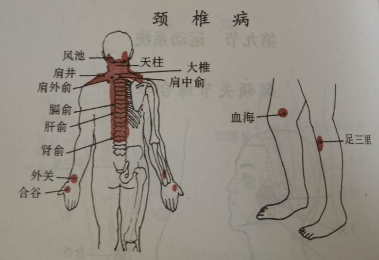 颈椎病民间偏方奇效方_颈椎病的最好治疗偏方_颈椎骨质增生的偏方