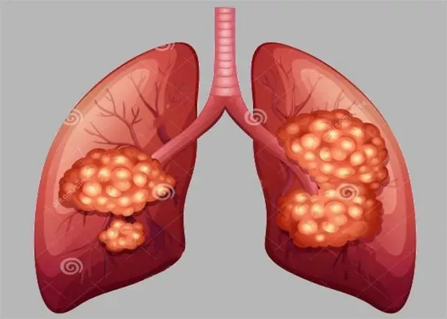 肺癌晚期偏方_肺癌晚期疼痛的偏方大全_肝癌肺癌晚期治疗偏方