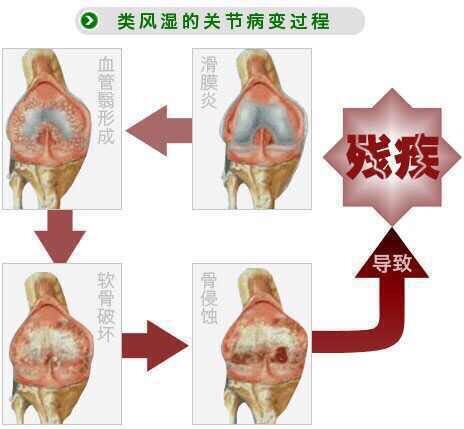 类风湿结节怎么治疗图片