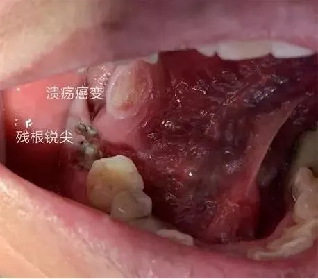 治疗口腔溃疡的偏方_口腔没有溃疡但是烧灼疼痛感_糖尿病口腔大面积溃疡愈合的秘方