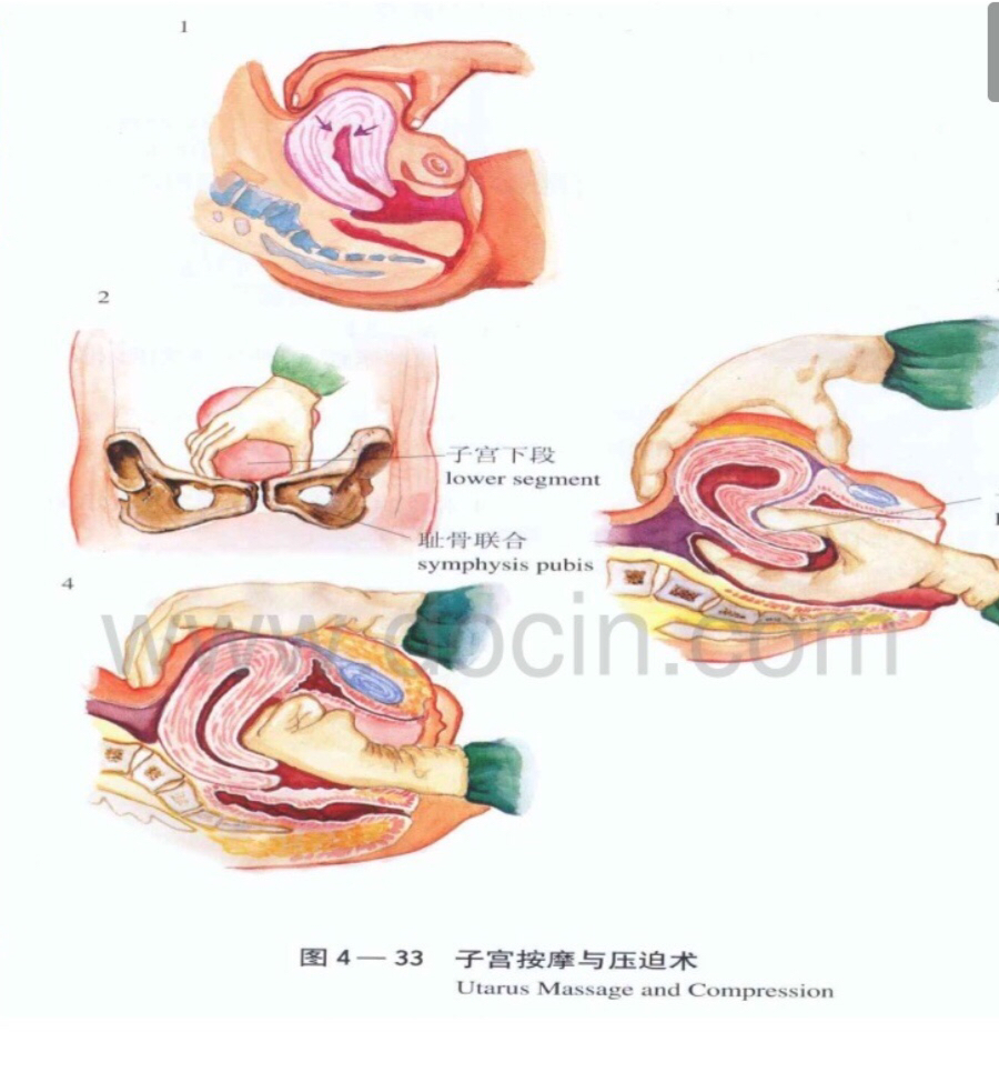 拉粑粑出血偏方_拉粑粑屁眼疼还出血了_拉粑粑出血是怎么回事