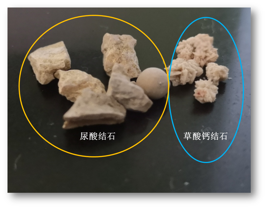 尿结石偏方_尿道管结石怎么形成的_尿道管结石怎么排出