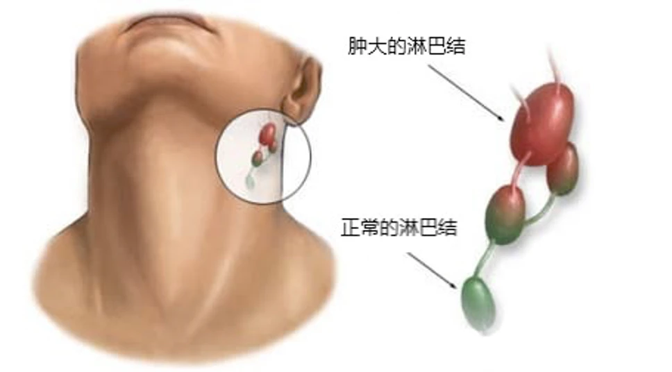 网肘炎怎么治疗_网肘炎最佳治疗偏方_网肘炎最佳治疗偏方