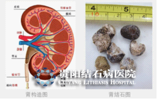 绝世秘方根治结石_中华秘方网秘方大全_结石秘方