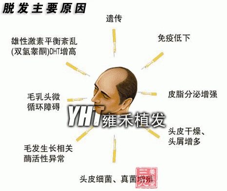 脂溢脱发原因_脂溢脱发可以痊愈吗_脂溢性脱发治疗偏方