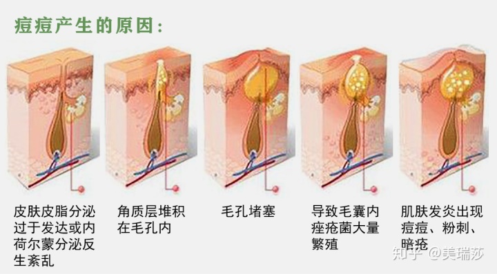 脸上长痘粉刺谁有去痘的偏方_去痘坑偏方_治痘偏方