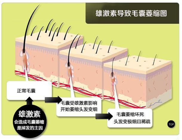 中医治疗遗传性脱发偏方_治疗脱发偏方_脂溢性皮炎脱发怎么治疗偏方