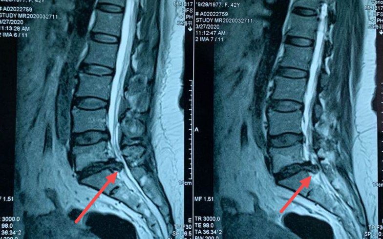 腰椎健盘突出怎么治疗_腰椎间盘突出特效断根秘方_治疗腰椎肩盘突出医院