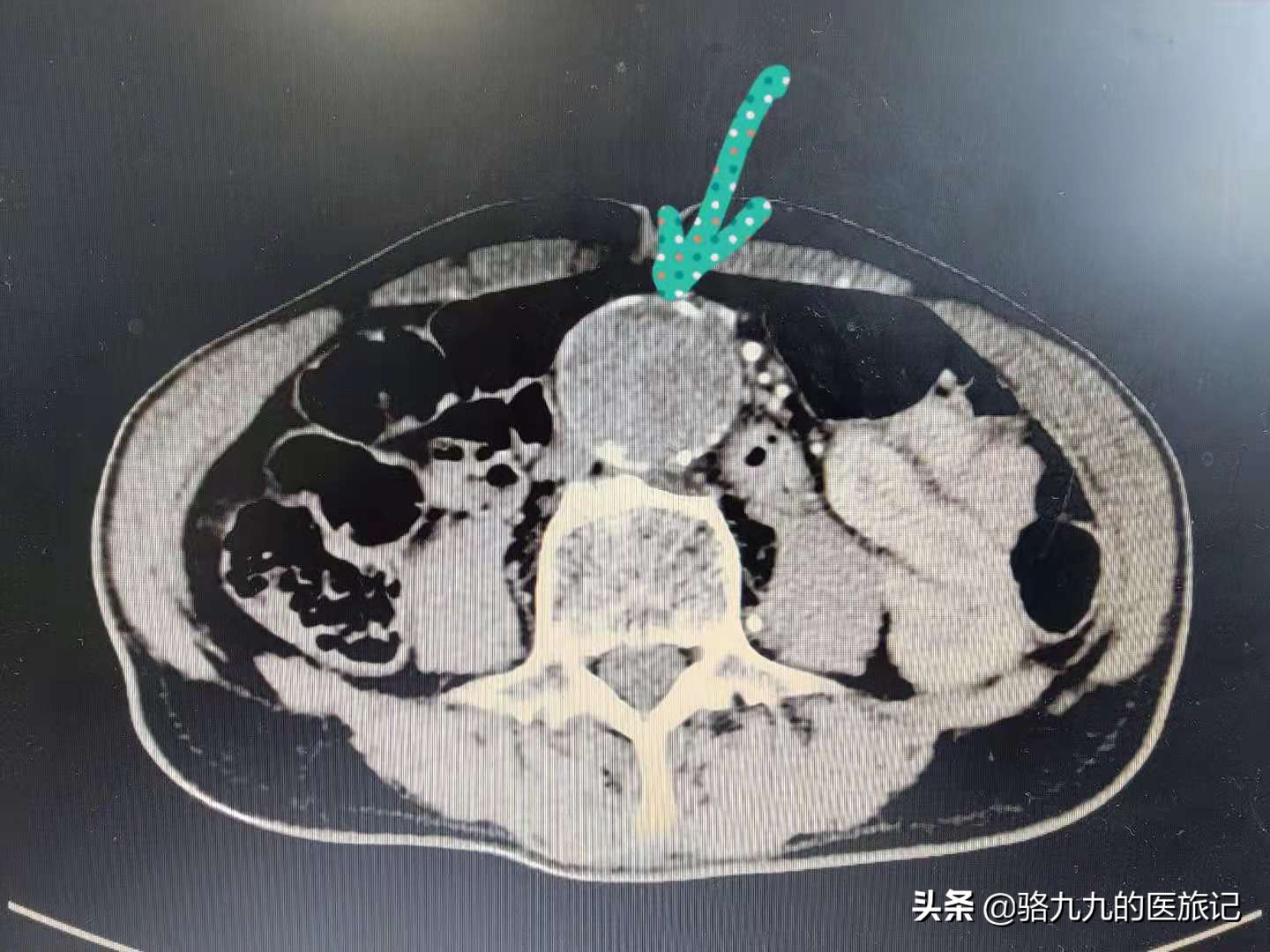 什么病使得75岁老人从下肢疼痛无力到过世只有数小时？