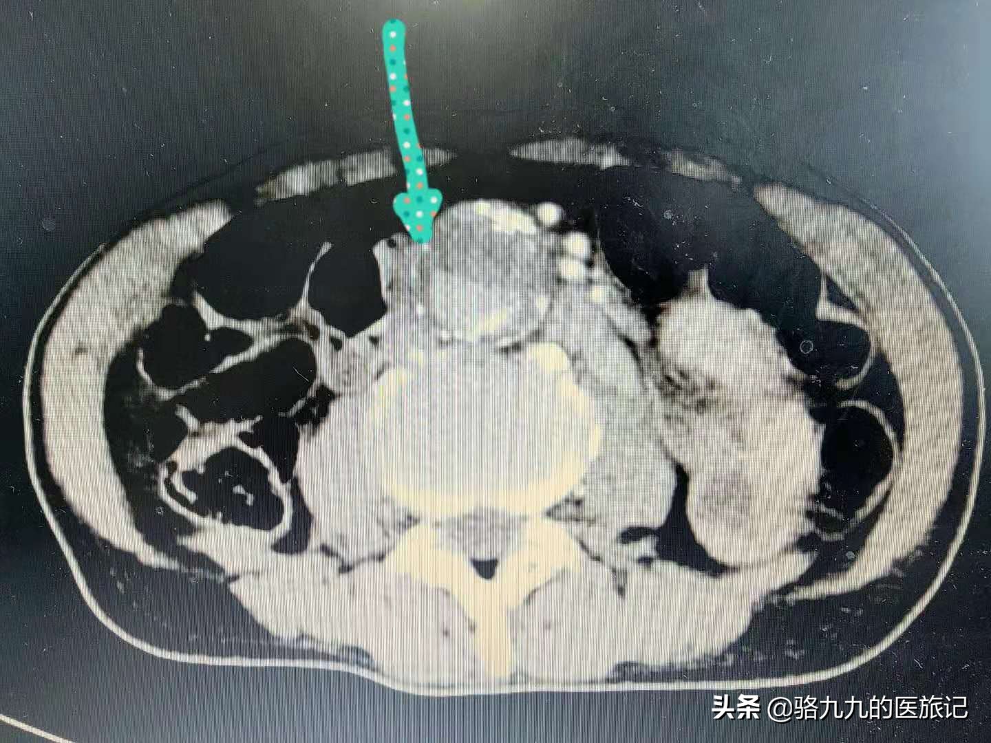 什么病使得75岁老人从下肢疼痛无力到过世只有数小时？