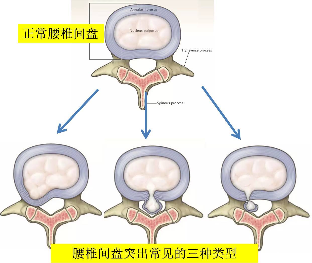 治腰突的外敷验方_土鳖黄瓜子三七磨粉治腰突吗_壮腰健肾丸治腰突