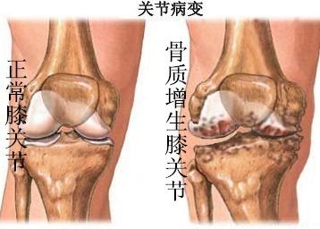 骨质关节炎怎么治疗_腰椎骨质轻度增生_治疗骨质增生的偏方