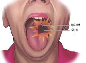 什么是慢性单纯性咽炎_慢性咽炎偏方_慢性肥厚性咽炎会癌变