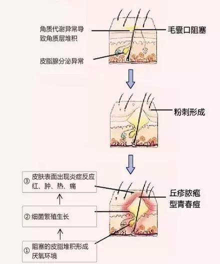 最古老治痘痘的偏方_皮肤偏方能治痘痘吗_猪油治皮肤干裂的偏方