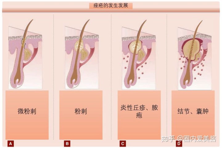 皮肤偏方能治痘痘吗_最古老治痘痘的偏方_猪油治皮肤干裂的偏方