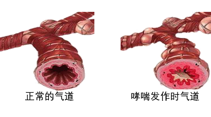 气管哮喘症状_气管痉挛哮喘_支气管哮喘偏方