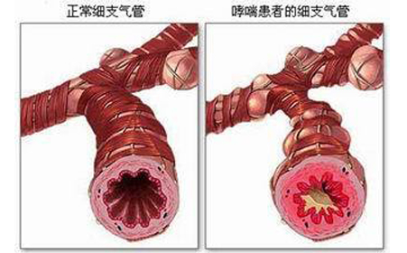 支气管哮喘偏方_气管痉挛哮喘_气管哮喘症状