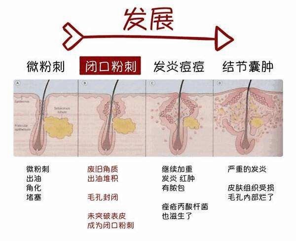 自制中药祛痘药膏配方_祛痘最有效的药膏_祛痘印祛痘最有效的药膏