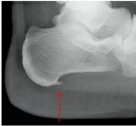 跟骨骨刺怎么办？