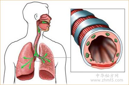 治疗支气管炎的偏方_哮喘是肺不好还是支气管不好_支气管炎和支原体炎治疗偏方