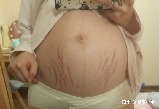 去妊娠纹偏方_去医院去妊娠纹多少钱_产后妊娠纹有偏方吗