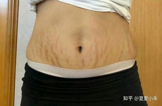 去医院去妊娠纹多少钱_去妊娠纹偏方_产后妊娠纹有偏方吗