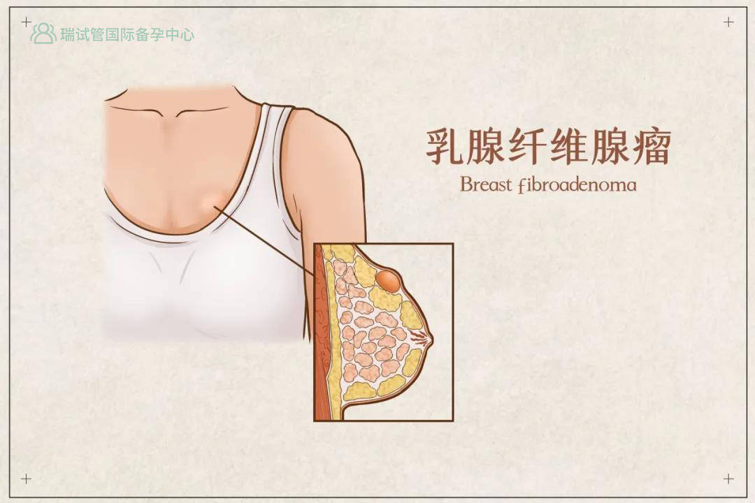 乳腺纤维腺瘤恶性能治疗好吗_乳腺结节民间治疗偏方_乳腺纤维瘤治疗偏方