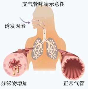 治疗气管炎的偏方_治病慢性澜尾炎偏方_慢性支气管炎偏方