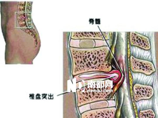 颈椎骨质增生偏方_腰椎骨质轻度增生_热透灸能治颈椎骨质曾生吗