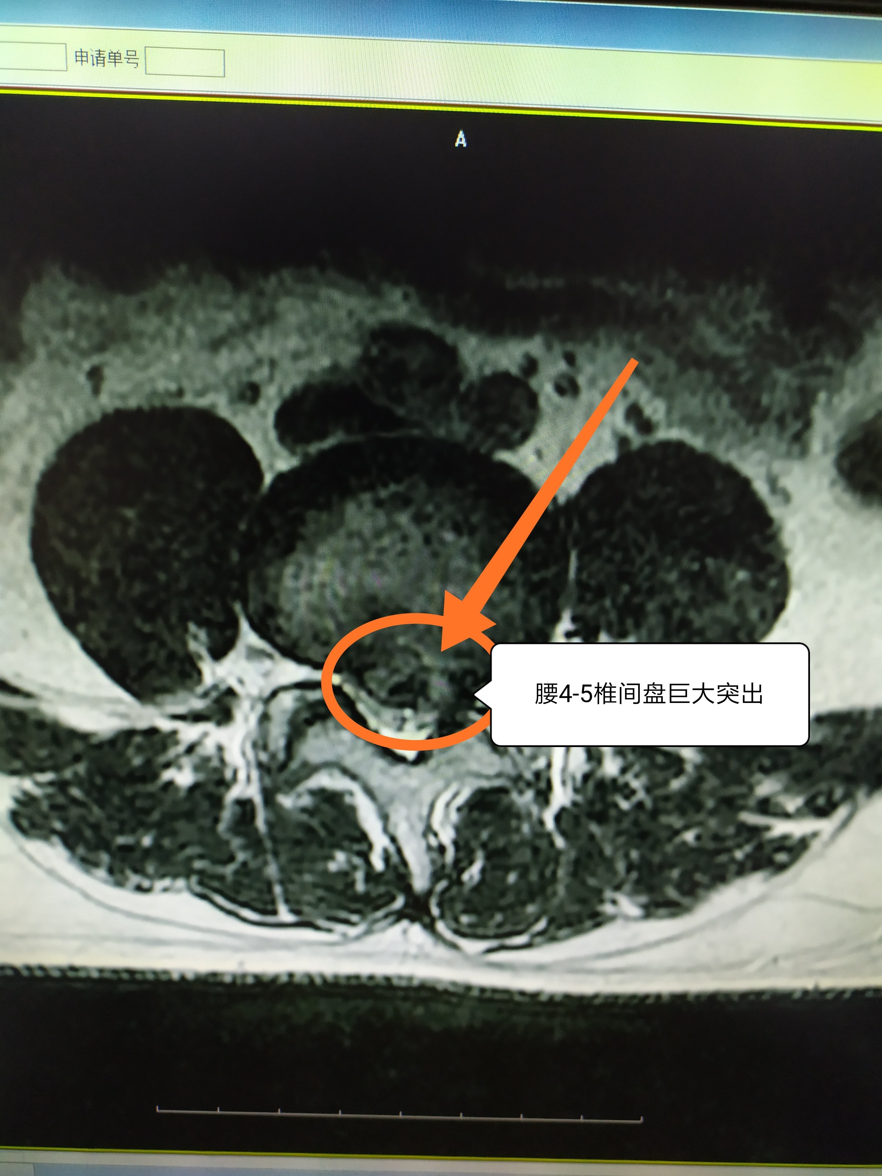 颈椎骨质增生偏方_北京哪家医院治颈椎骨质增生好_颈椎骨质轻度增生