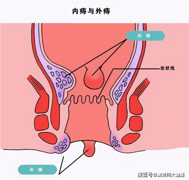 治痔疮偏方_痔疮的偏方_痔疮中药偏方