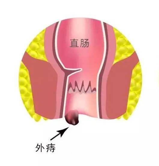 痔疮中药偏方_痔疮的偏方_治痔疮偏方