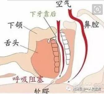 很老的老偏方治疗胃酸胃痛的偏方_偏方治疗打呼噜_呼噜呼噜小精灵第一季