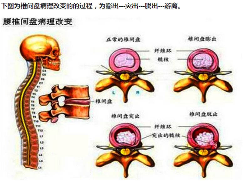 腰椎间盘突出症的治疗偏方_腰椎间盘突出症偏方_腰椎尖盘突出症的治疗