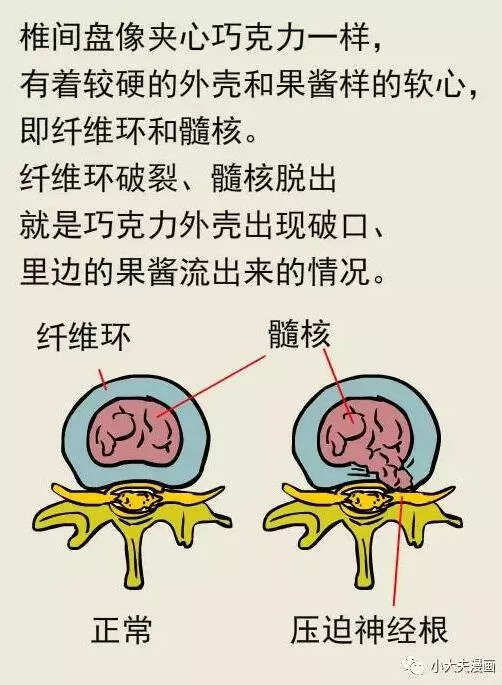 「名医」腰椎间盘突出总是治不好？治疗方法错了or没有坚持！