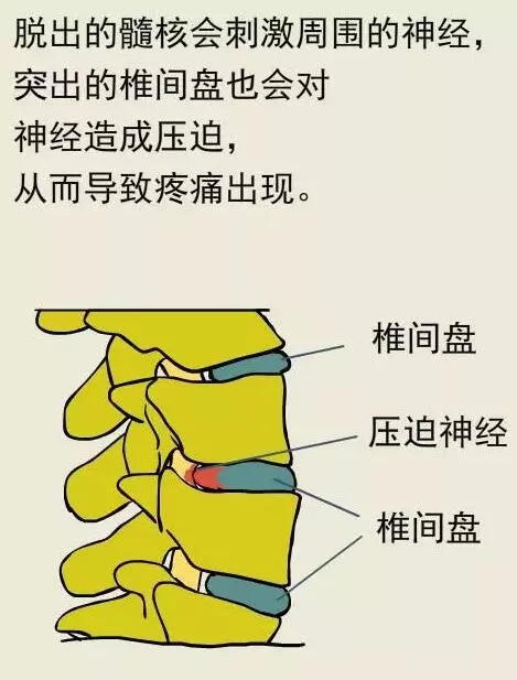 「名医」腰椎间盘突出总是治不好？治疗方法错了or没有坚持！