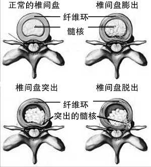 治疗腰椎肩盘突出_腰椎间盘突出症的治疗偏方_腰椎肩盘突出症