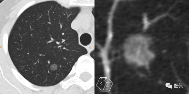 张仲景治乳腺增生结节偏方_张文彭治肺结节可靠吗_治肺结节偏方