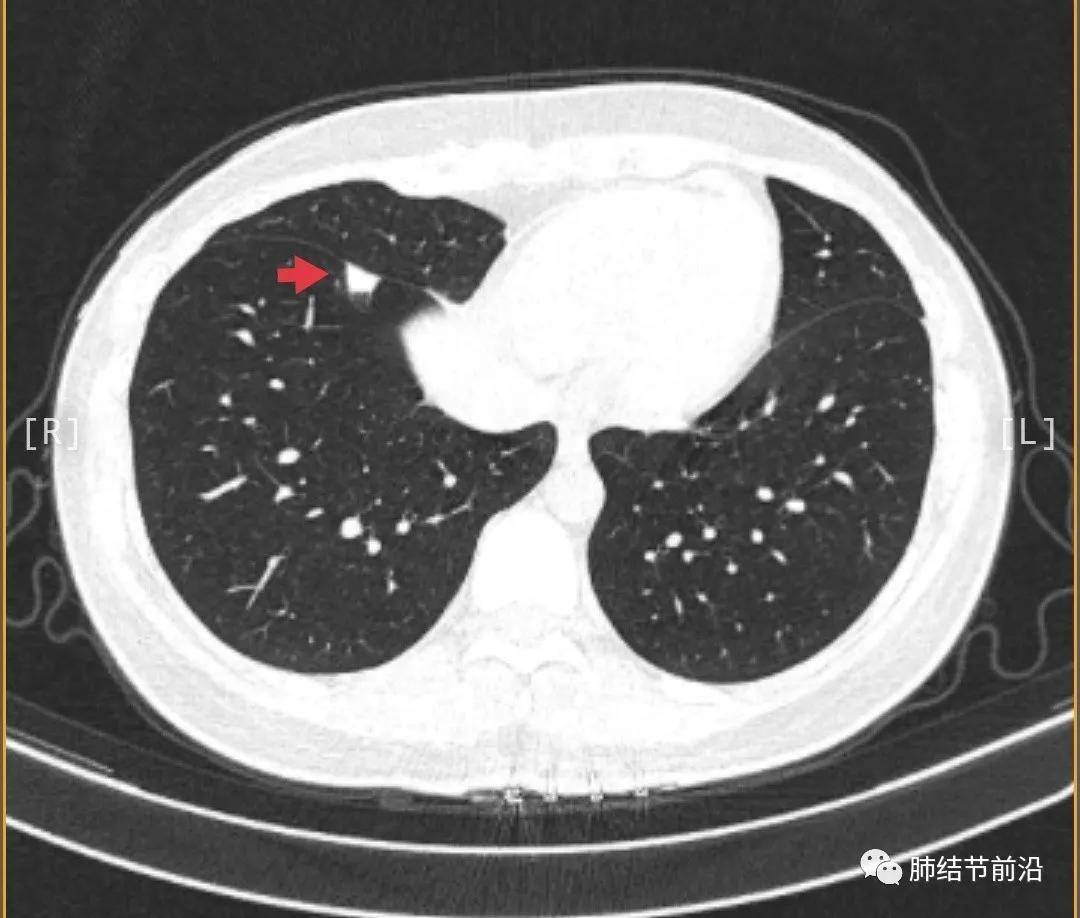 张文彭治肺结节可靠吗_治肺结节偏方_张仲景治乳腺增生结节偏方