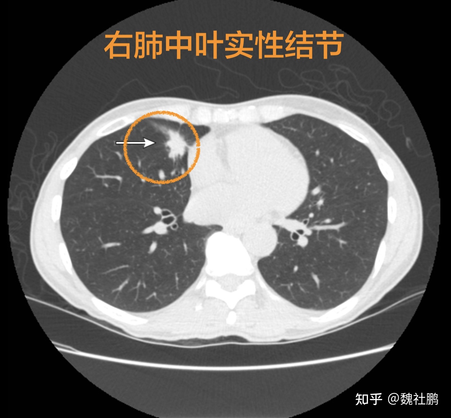 治肺结节偏方_张仲景治乳腺增生结节偏方_张文彭治肺结节可靠吗