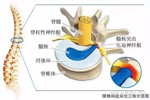 李时珍哮喘断根秘方_腰椎间盘特效断根秘方_颈腰椎骨质增生特效中药秘方